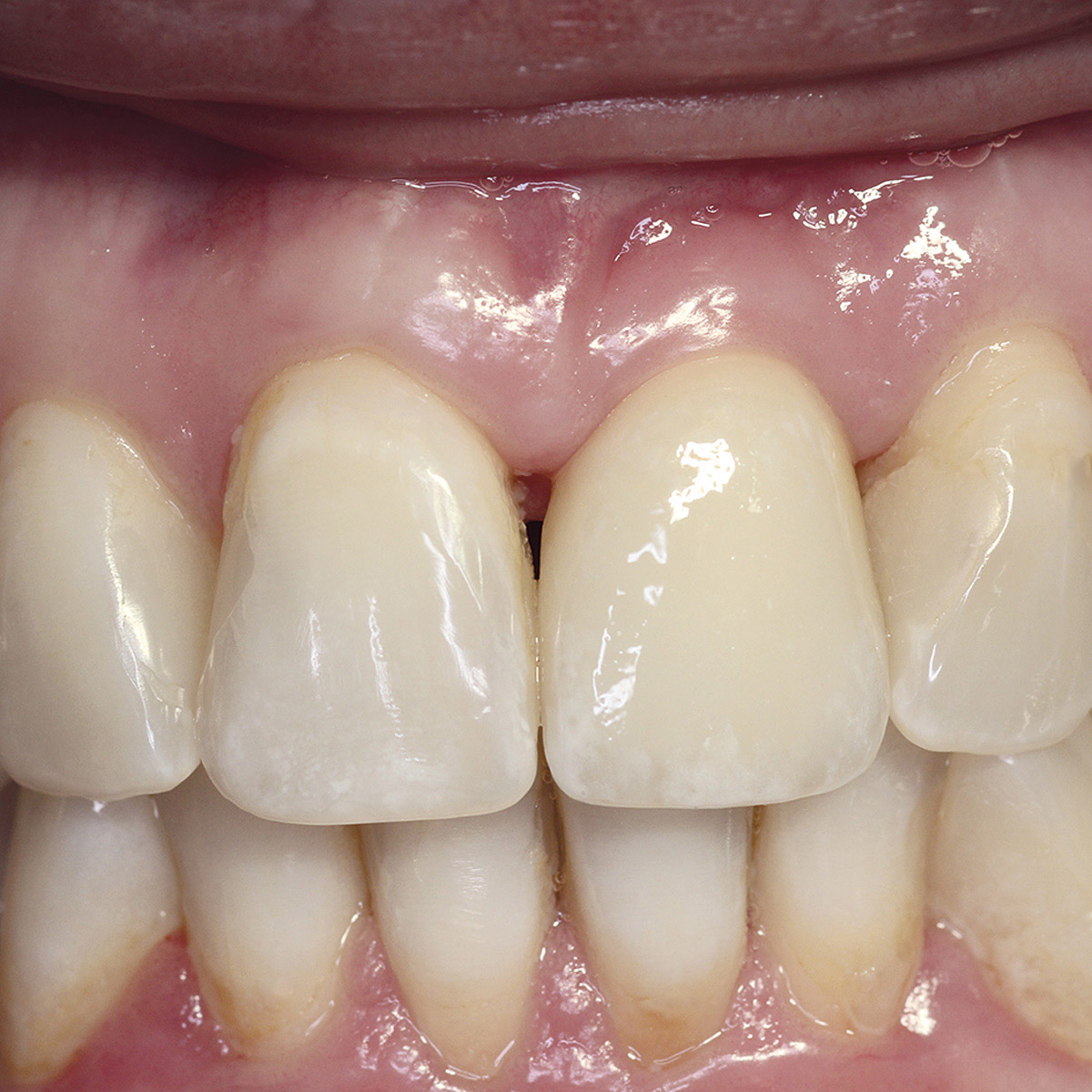 eingesetzte Totalprothese