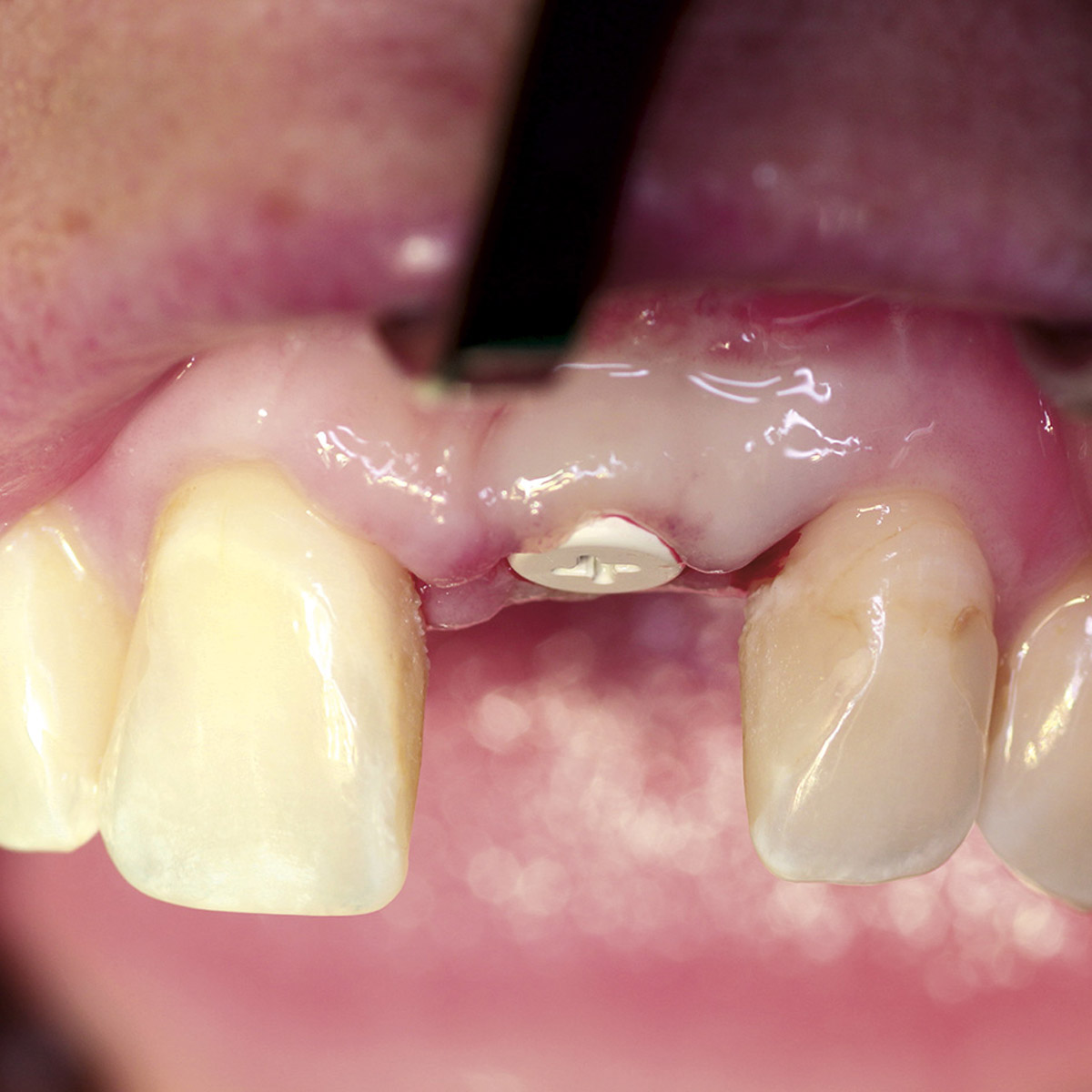 eingesetzter Implantatkörper