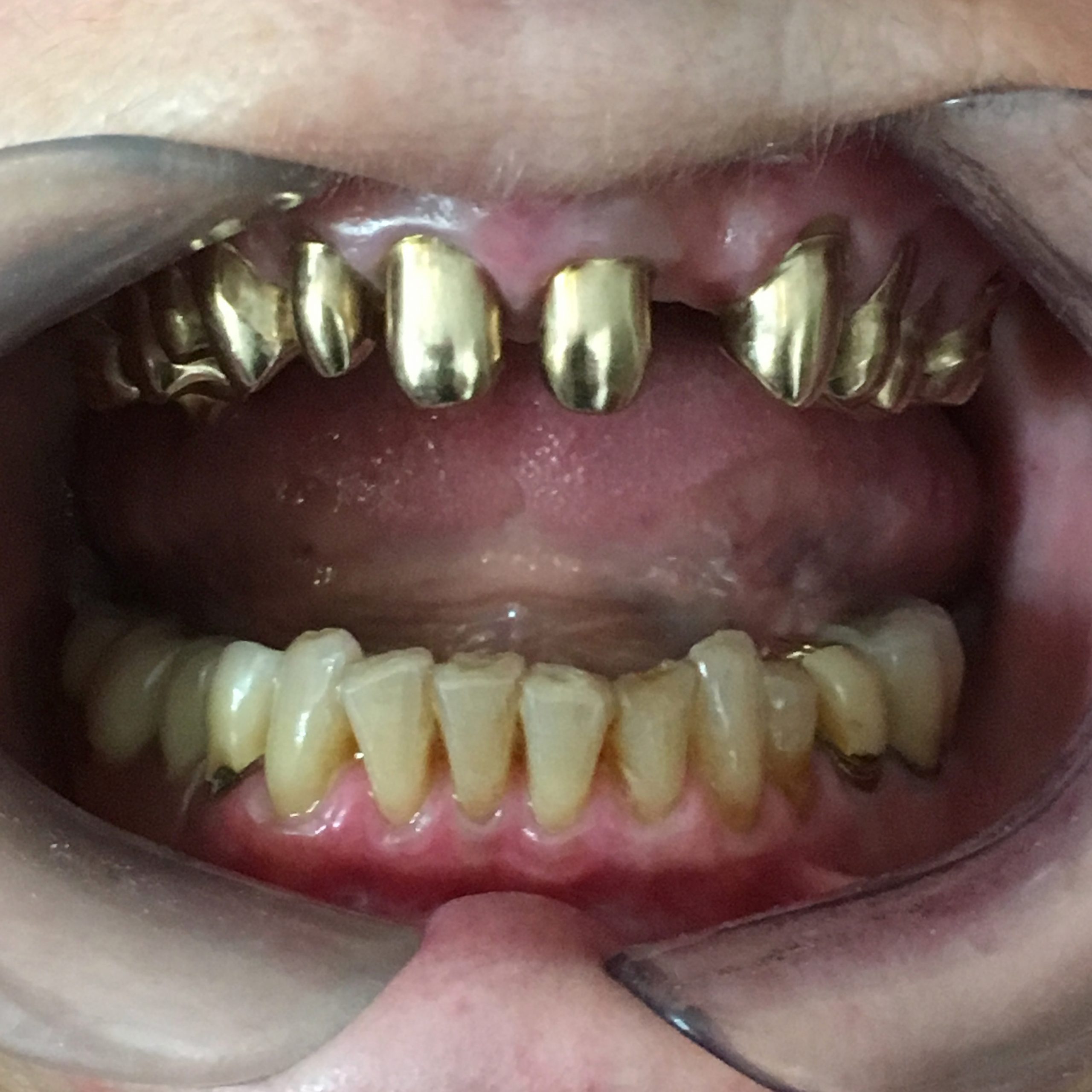 eingesetzte Innenteleskope