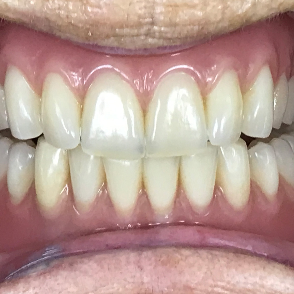 eingesetzte Totalprothese